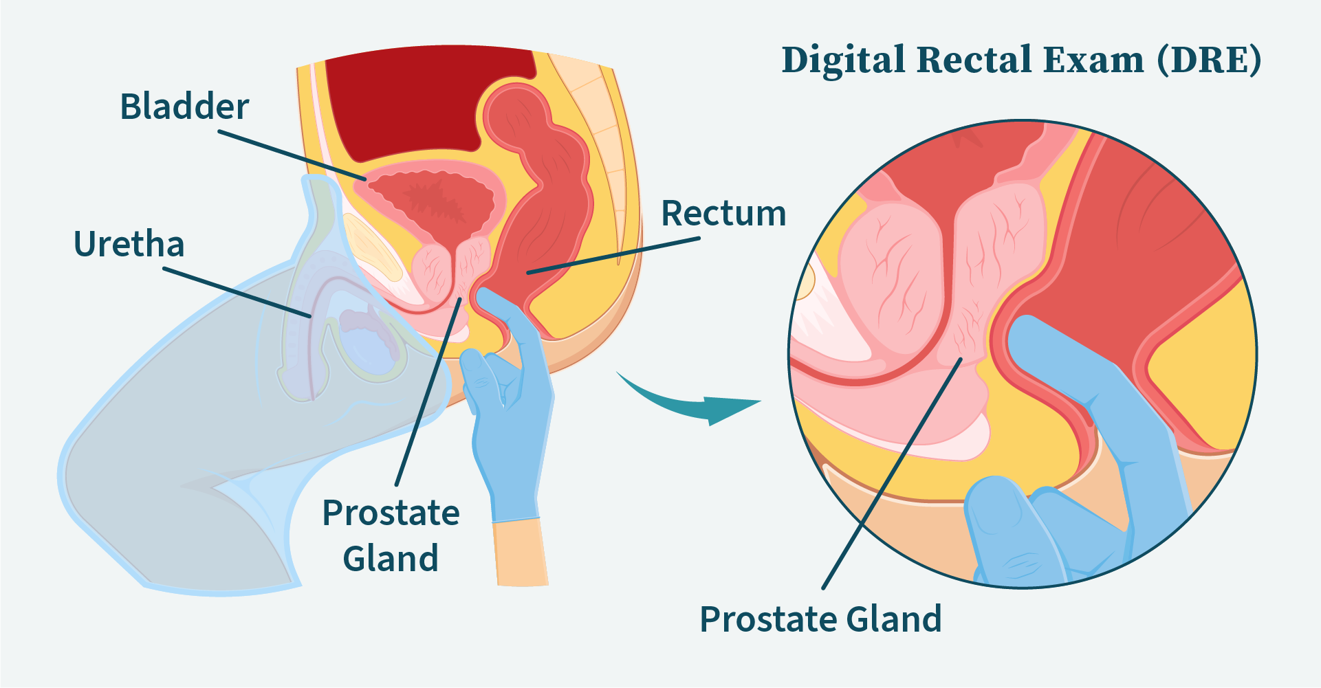Trouble Urinating: Is My Prostate Enlarged? Trouble Urinating: Is My Prostate Enlarged?