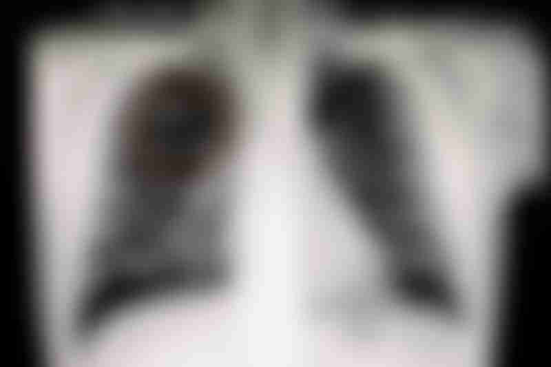 Lung Nodule