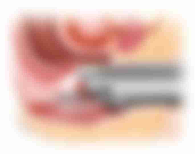 Colonoscopy Rectal Tumor Removal
