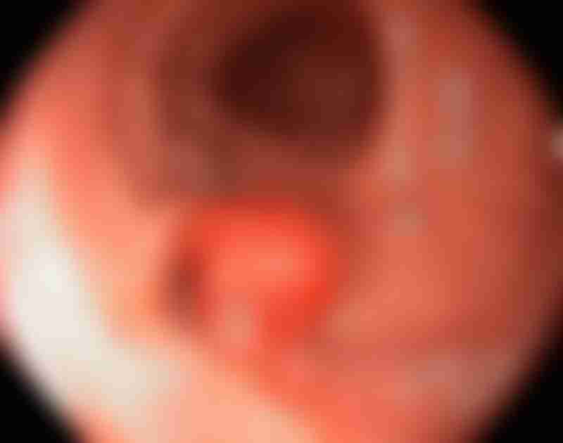 Tubular Adenoma