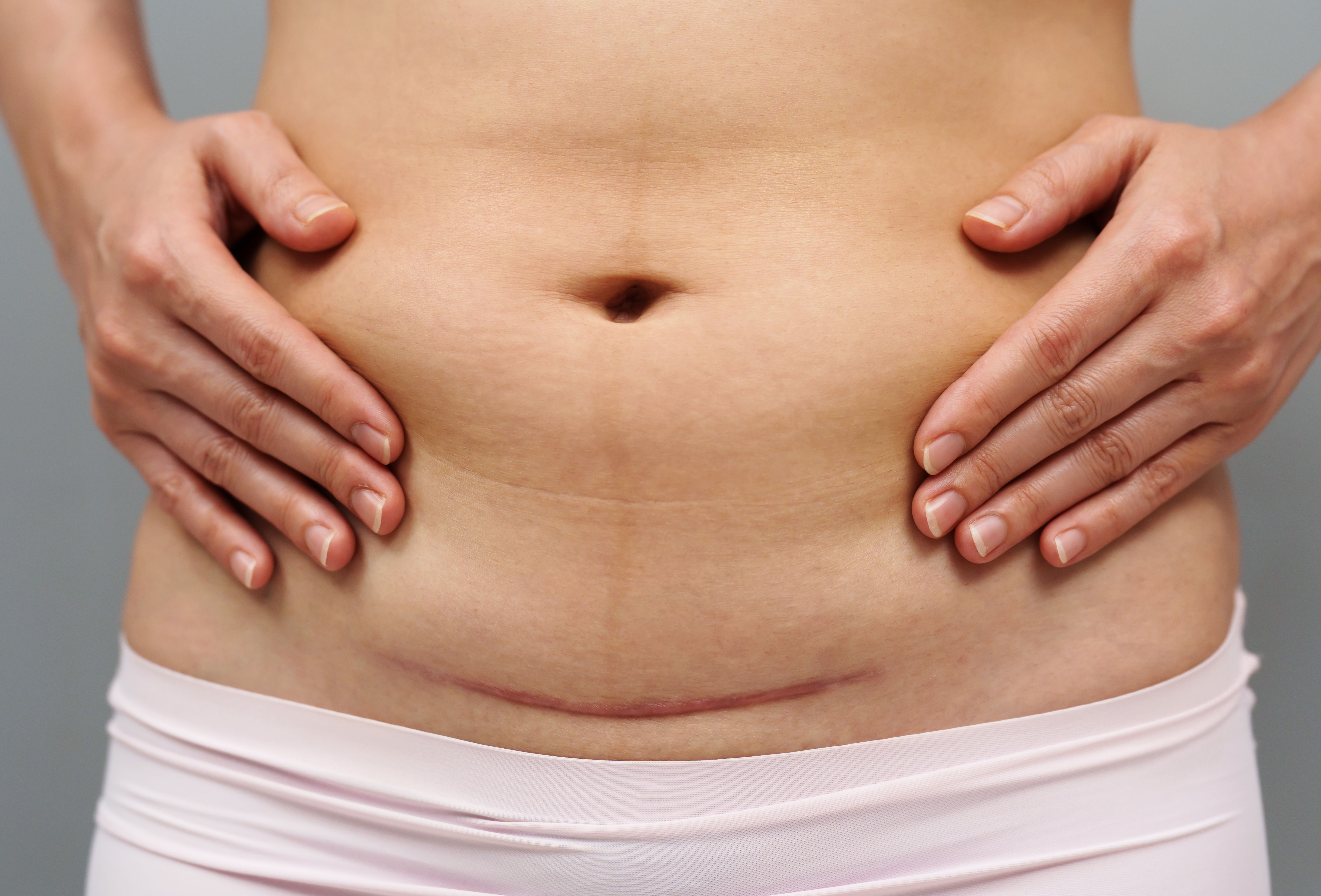 Close up of a abdomen scar