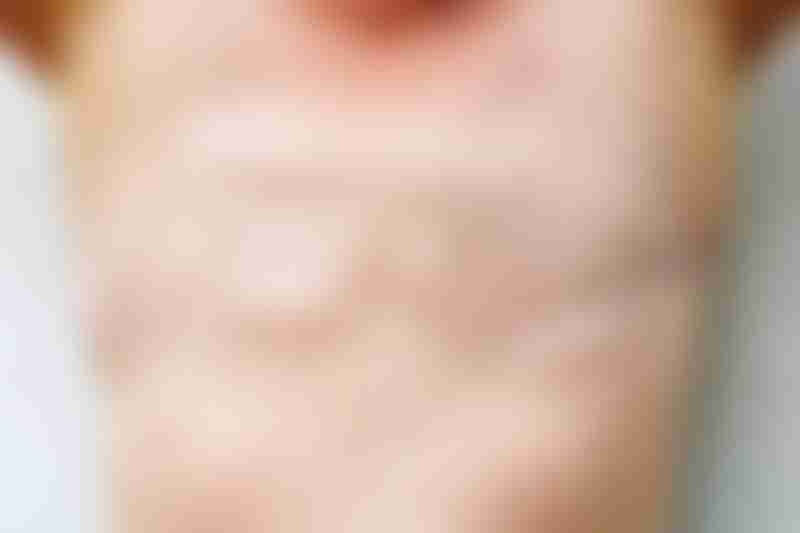 Double Mastectomy