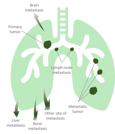 SCLC Extensive Stage