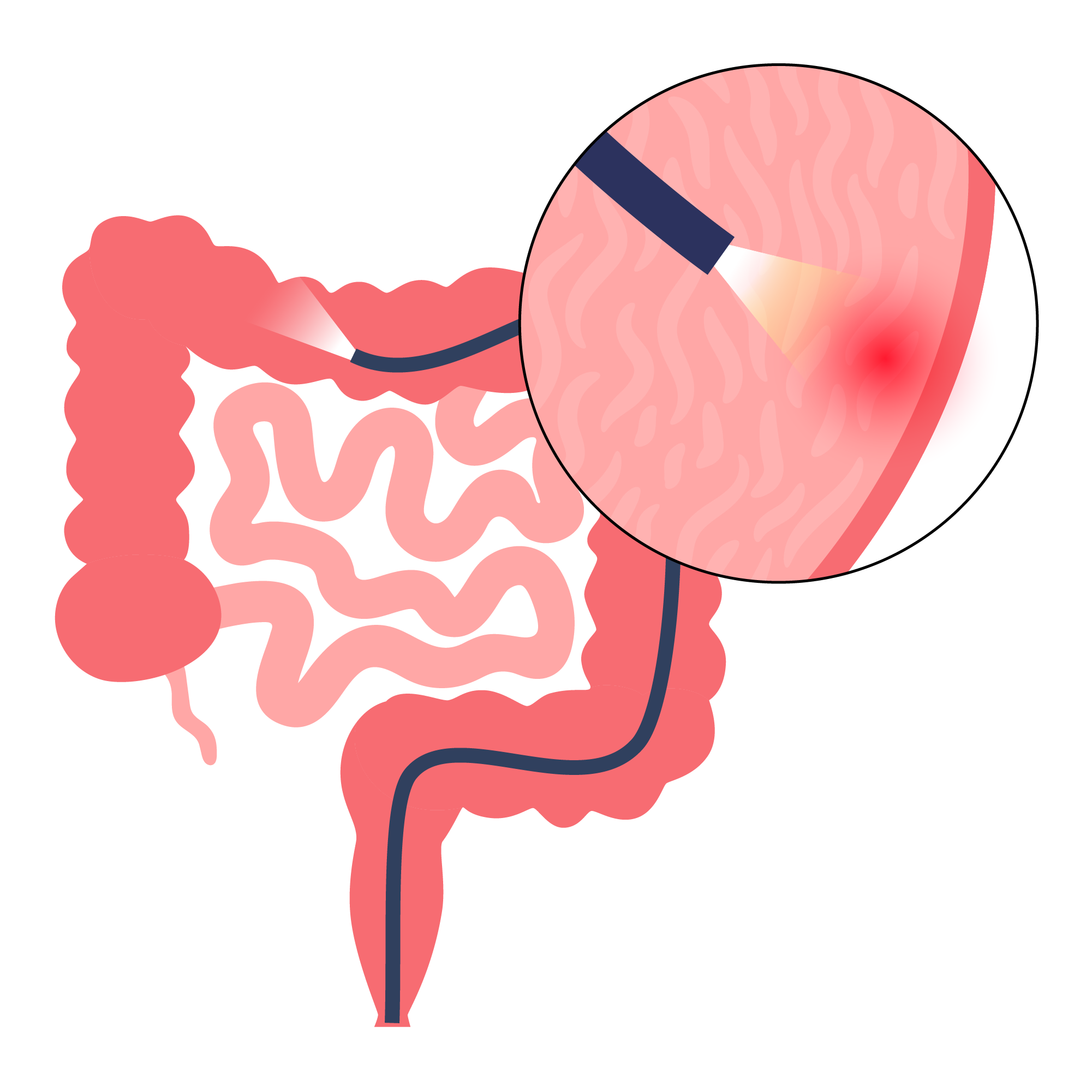Symptoms Colonoscopy Bowel Screening