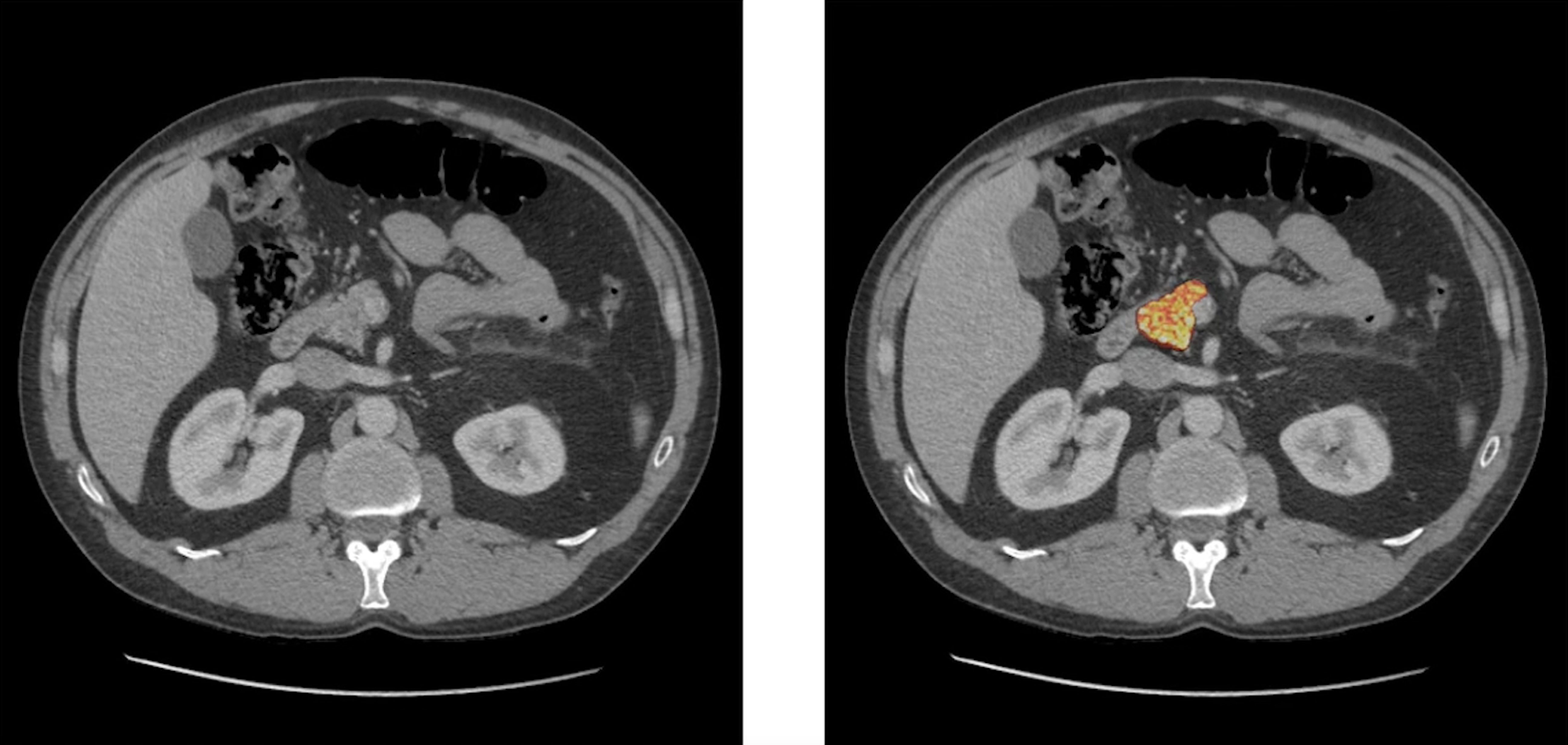 cancer image