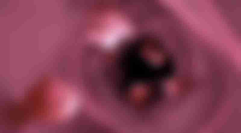 Pedunculated Polyps 3D Rendering
