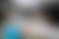 External Radiotherapy Prostate Cancer