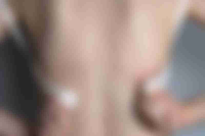 Bra Marks on Back of Woman