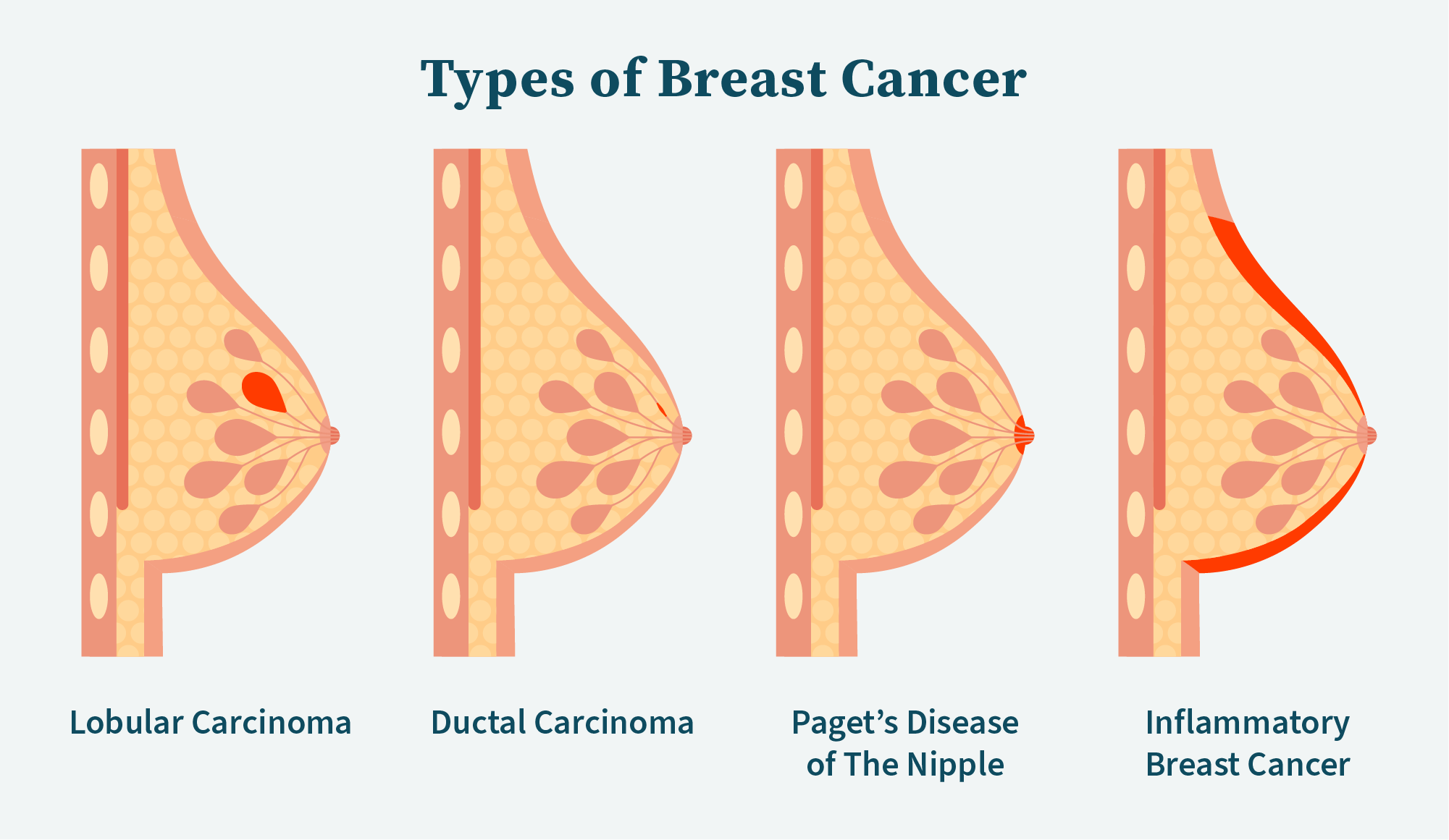 Types of Breast Cancer