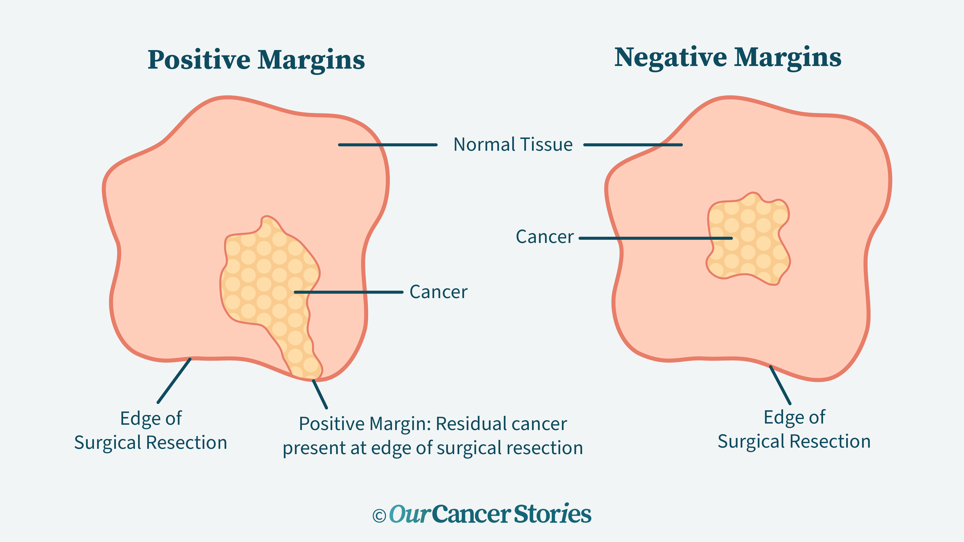 liver-cancer-tumor-surgical-margins