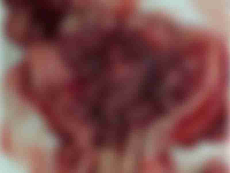 Uterine Cancer