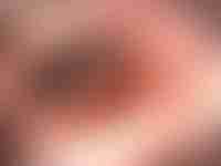 Colorectal Tumor 3D Render