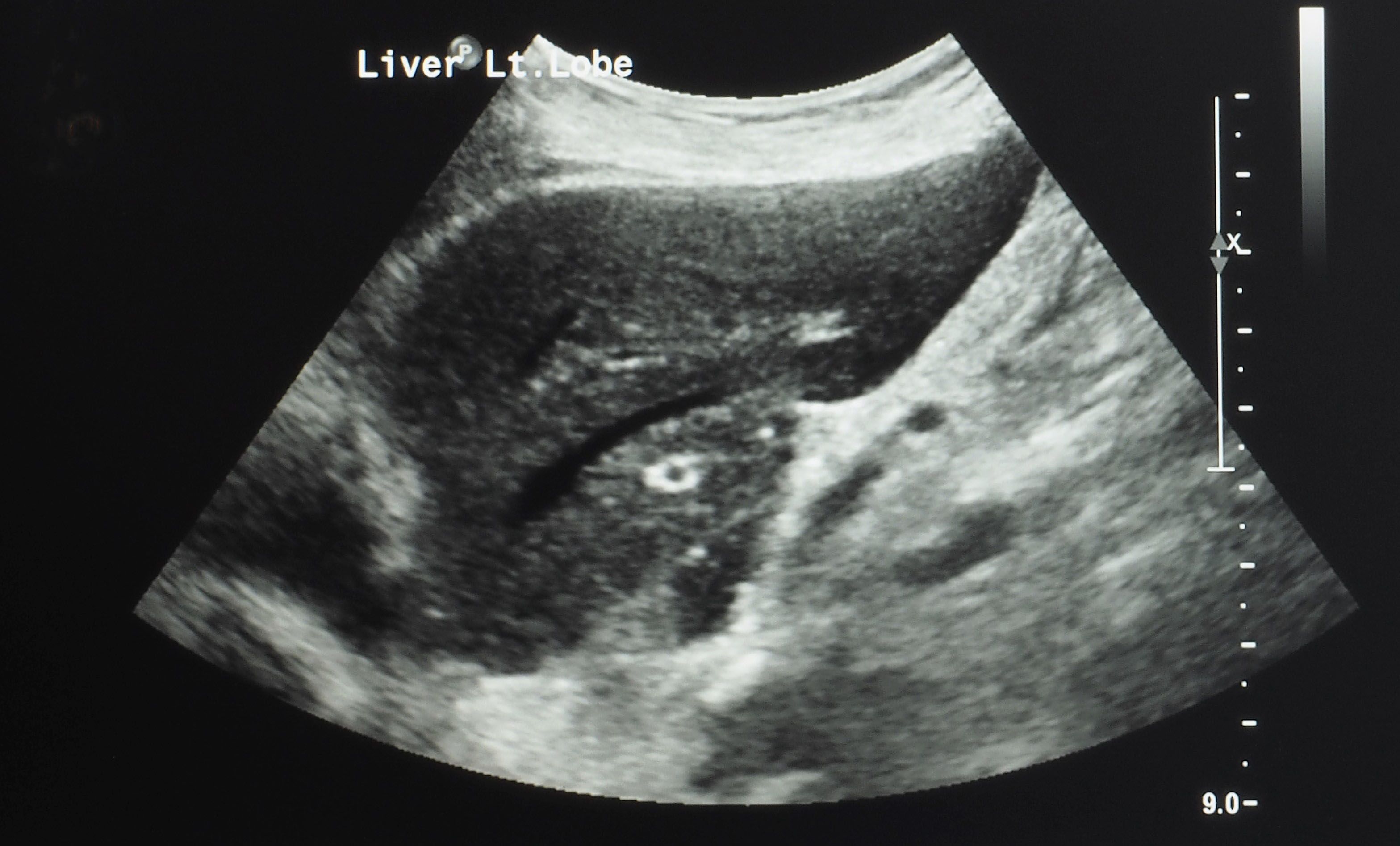 An ultrasonography image of upper abdomen