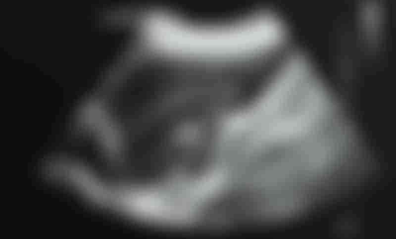An ultrasonography image of upper abdomen