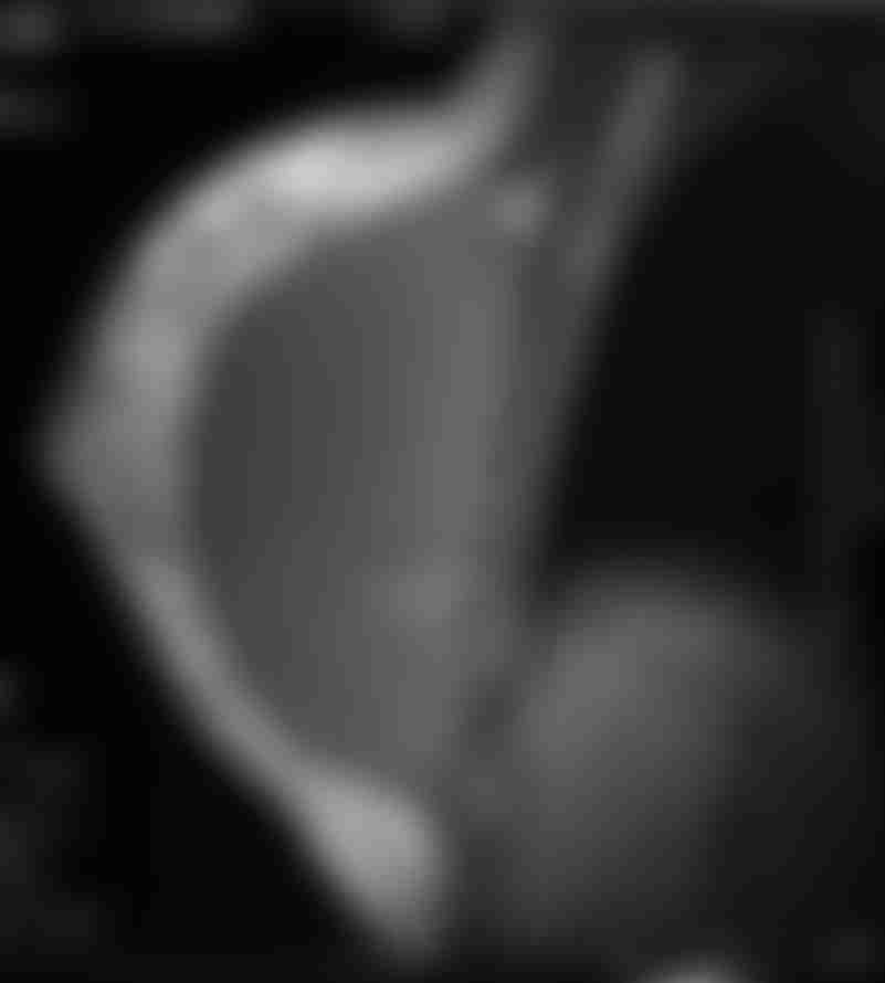 Breast Xray Image