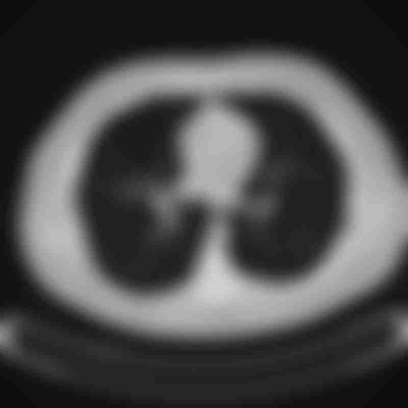 CT Thorax Lungs
