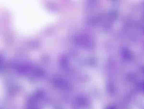 Lung Small Cell Carcinoma by Core Needle Biopsy