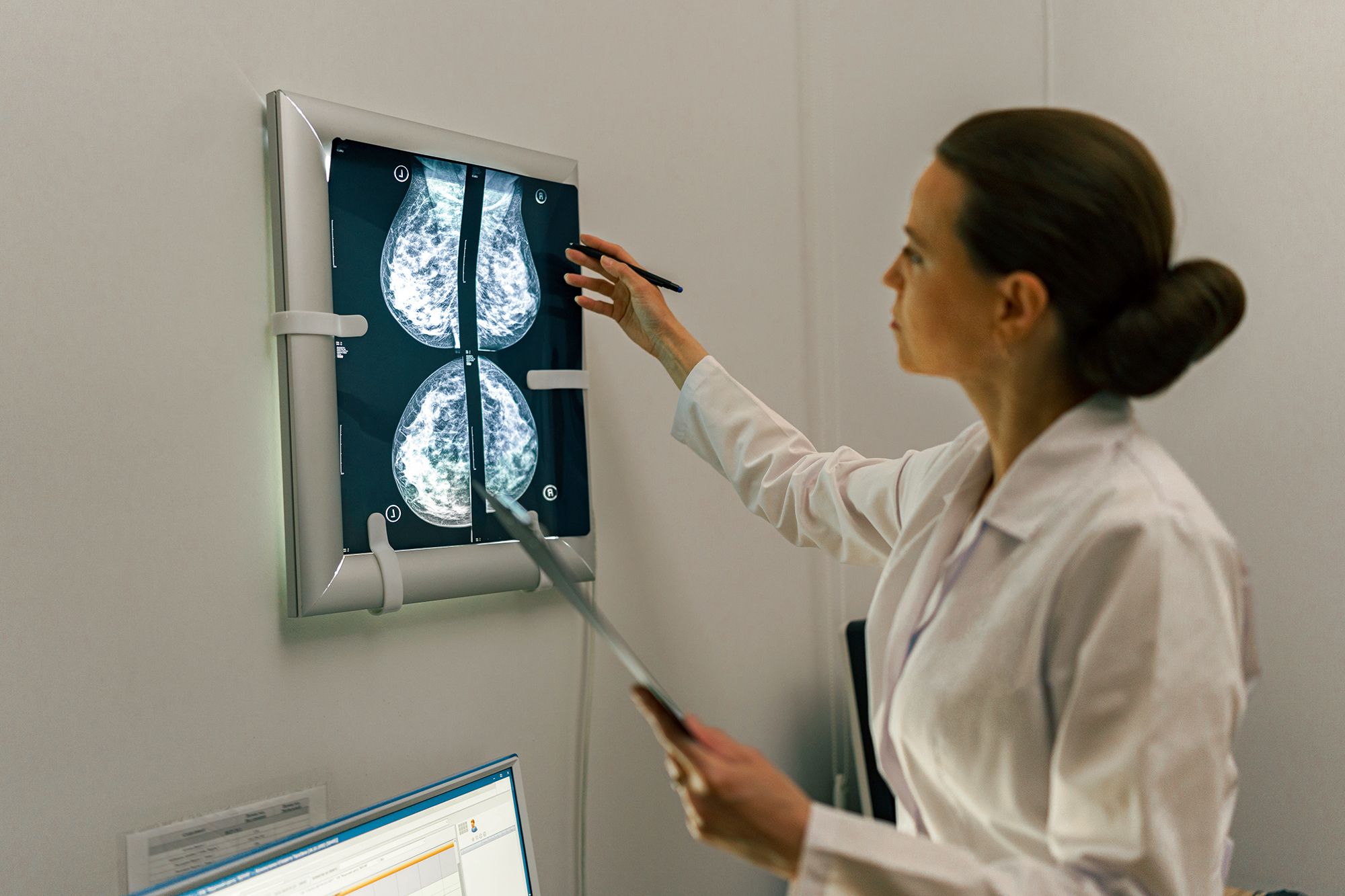 Lobular Carcinoma In Situ