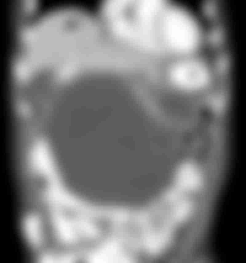 CT Liver Gastric NETs