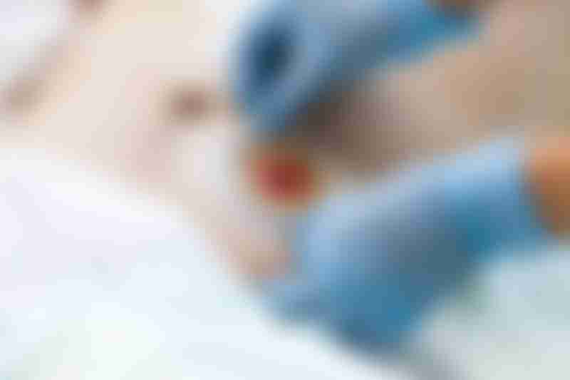 Man with Colostomy