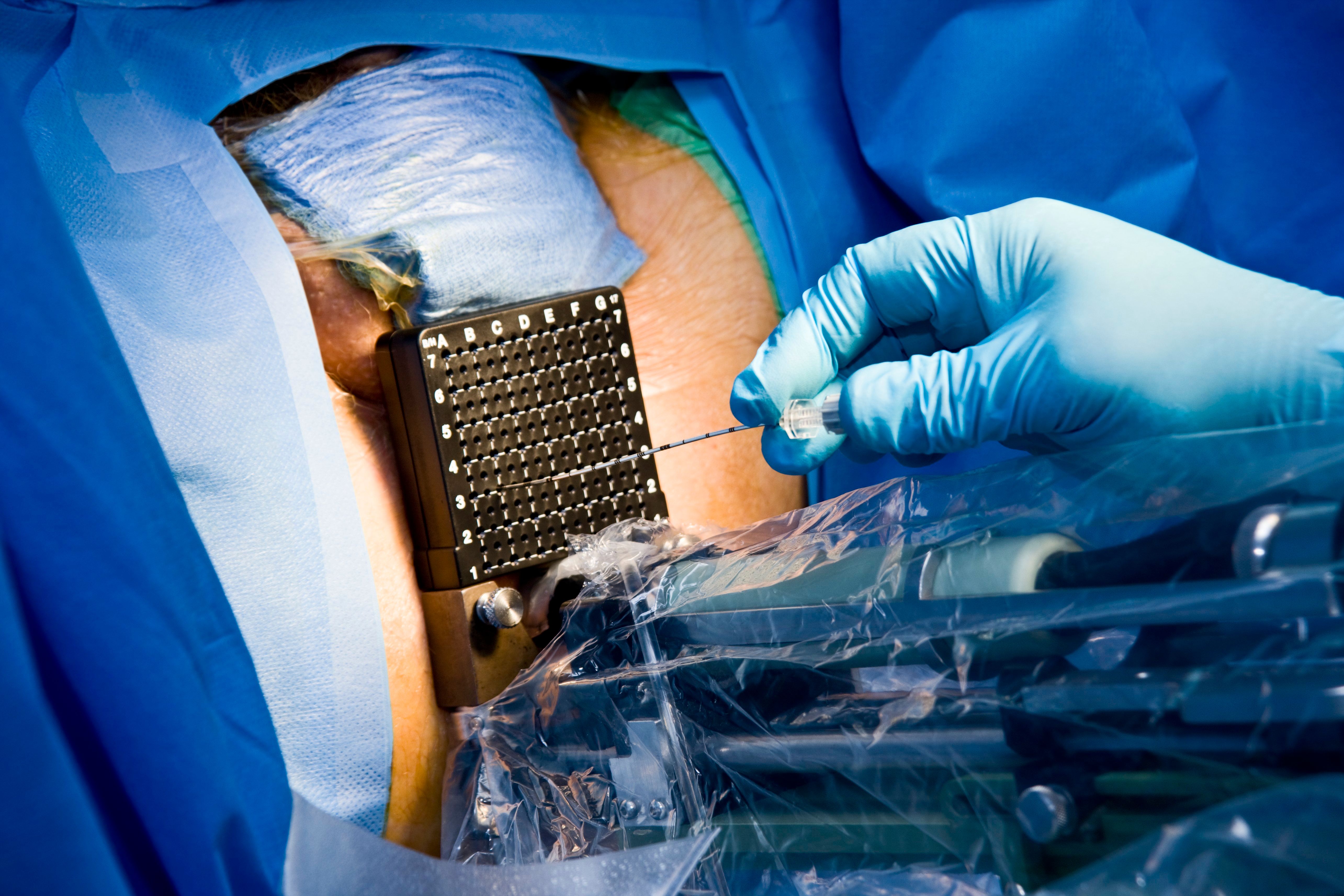 High-Dose Rate Brachytherapy