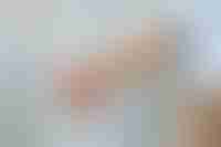 Patient Receiving Chemotherapy Intravenously