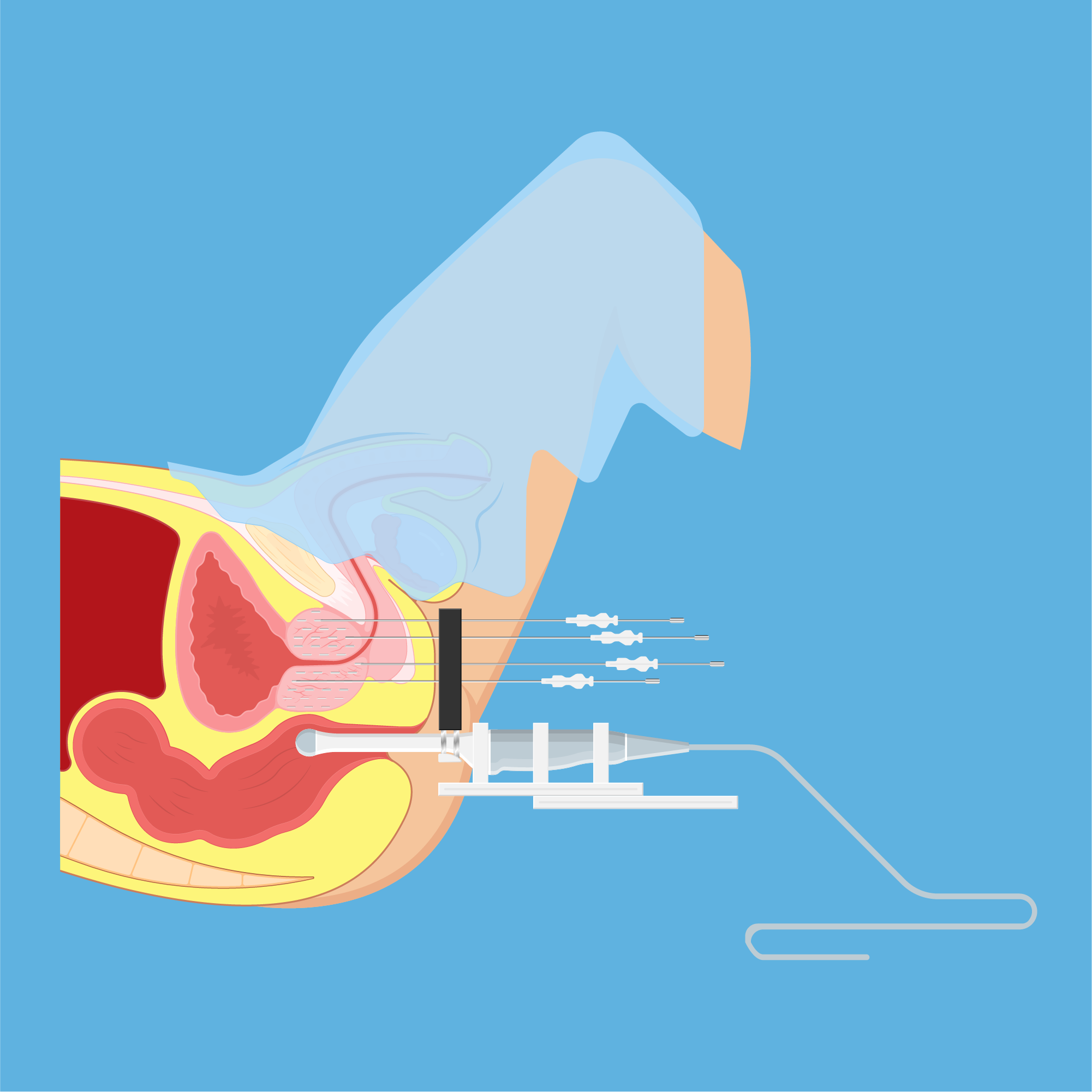 Medical Care Brachytherapy