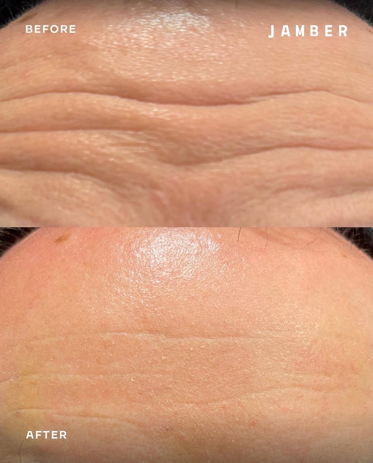 Jamber PDO thread lift before and after, patient case 10 of 43, unretouched clinical photo