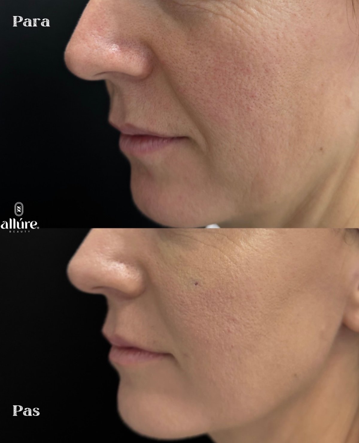 Jamber PDO thread lift before and after, patient case 13 of 43, unretouched clinical photo