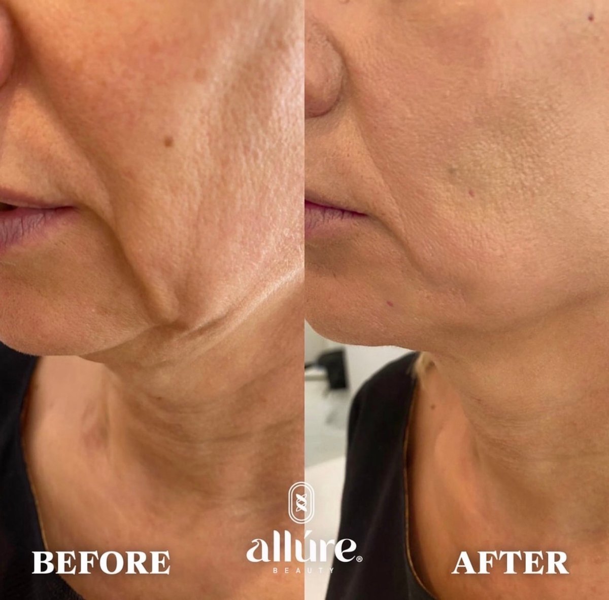 Jamber PDO thread lift before and after, patient case 14 of 43, unretouched clinical photo