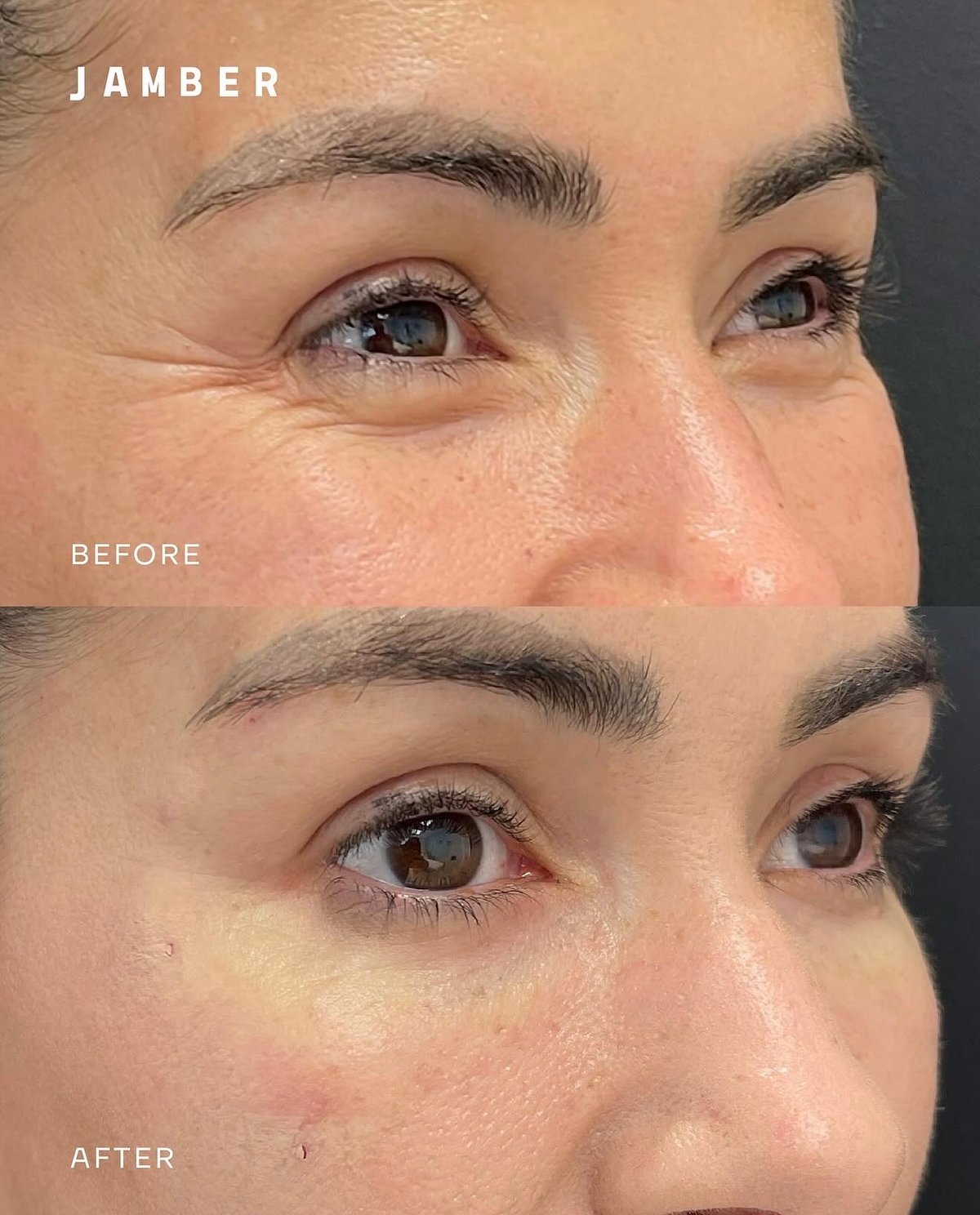 Jamber PDO thread lift before and after, patient case 11 of 43, unretouched clinical photo