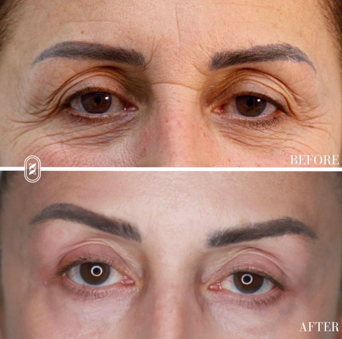 Jamber PDO thread lift before and after, patient case 15 of 43, unretouched clinical photo