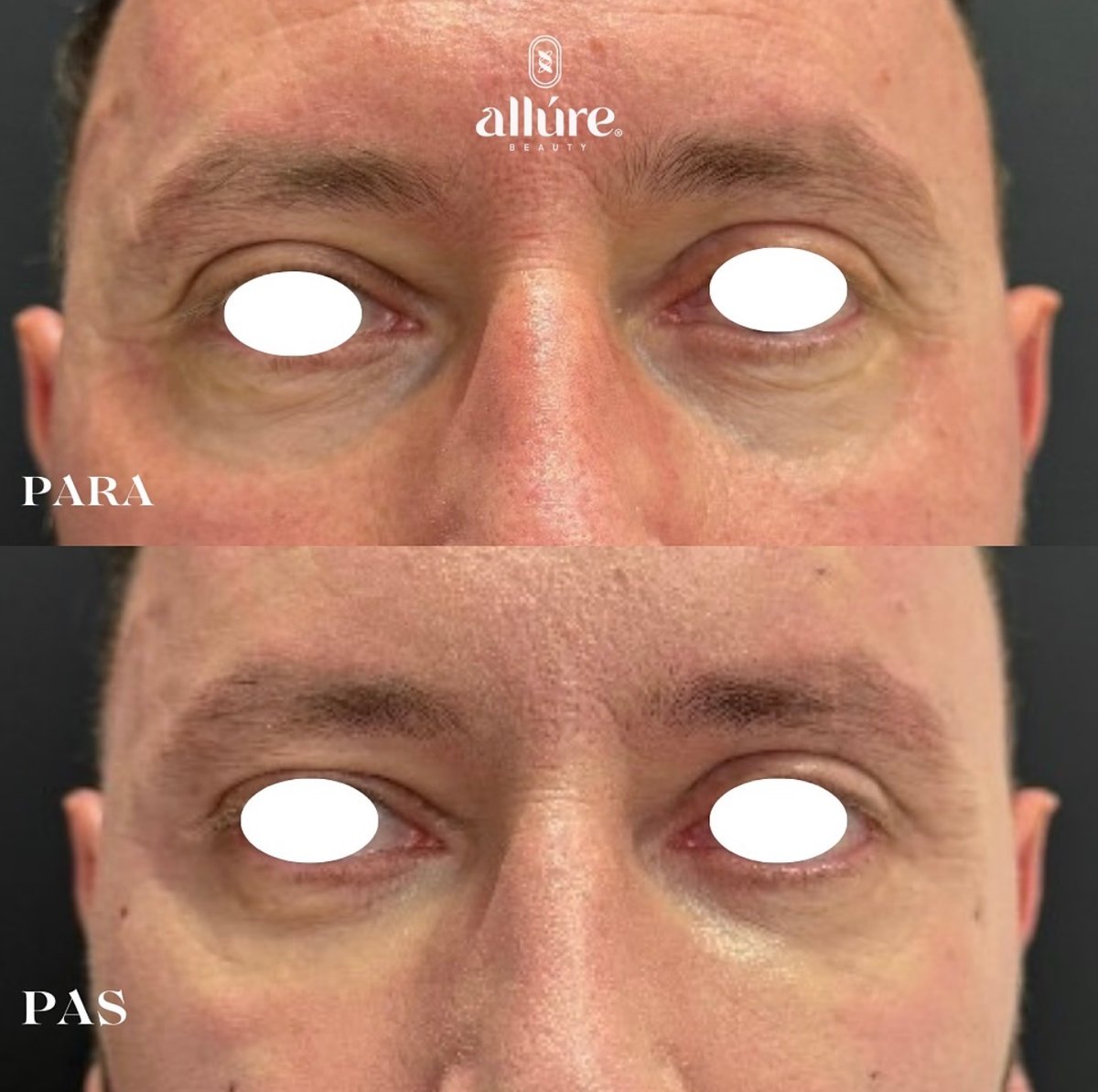 Jamber PDO thread lift before and after, patient case 12 of 43, unretouched clinical photo