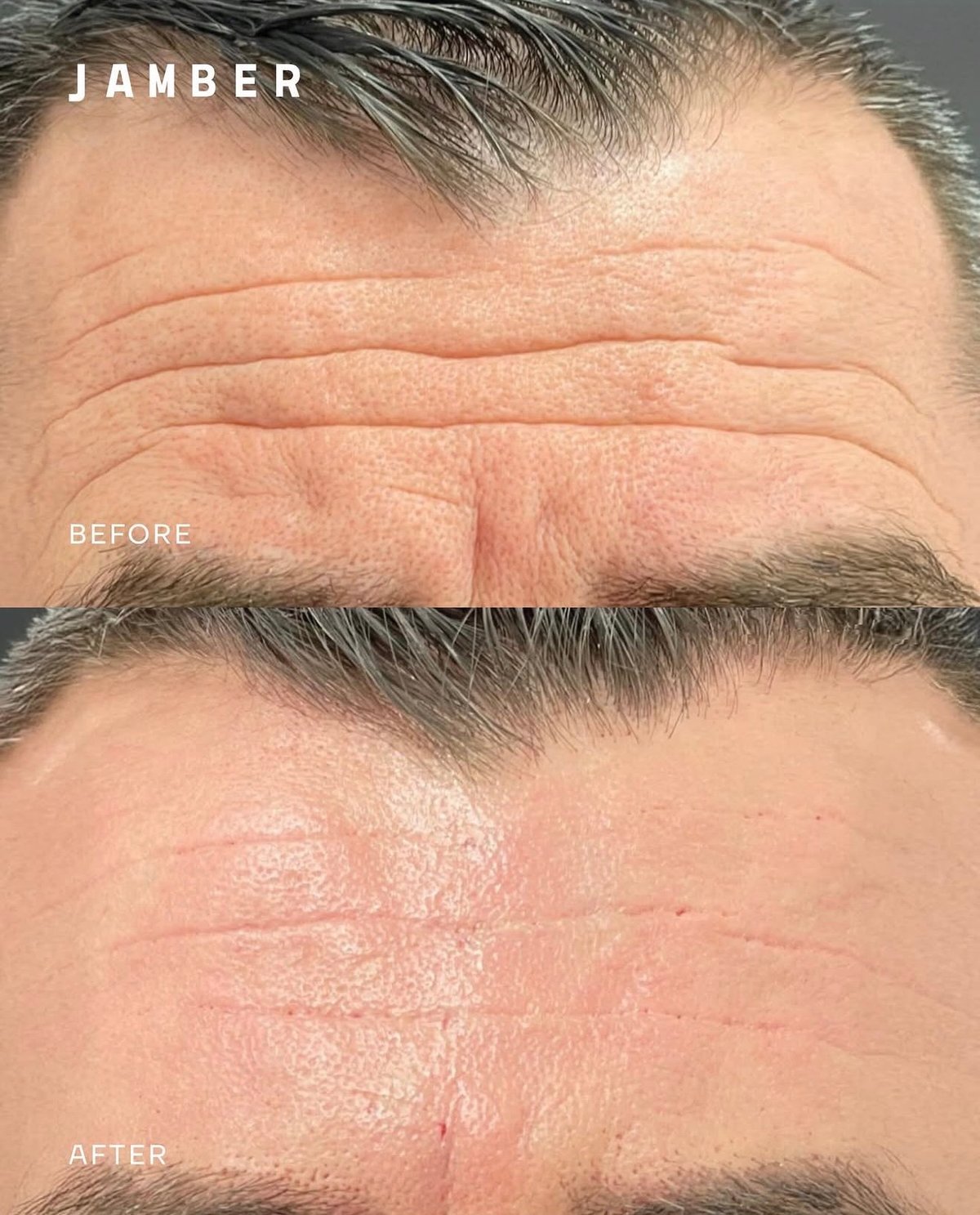 Jamber PDO thread lift before and after, patient case 9 of 43, unretouched clinical photo