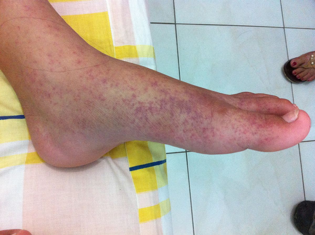 Chikungunya