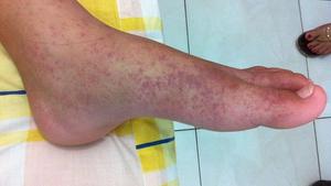 Chikungunya