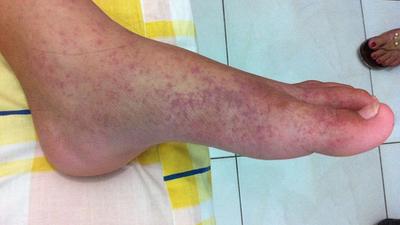 Chikungunya