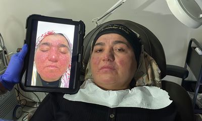 Gül Hastalığı Nedeniyle 20 Yıl Evden Çıkamadı: Sivas’ta Başlayan Tedaviyle Hayata Yeniden “Merhaba” Dedi