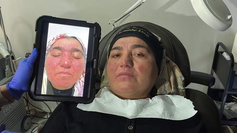 Bir kadın, tedavi öncesi ve sonrası yüzünün fotoğrafını tutuyor. Yüzünde kızarıklıklar var.