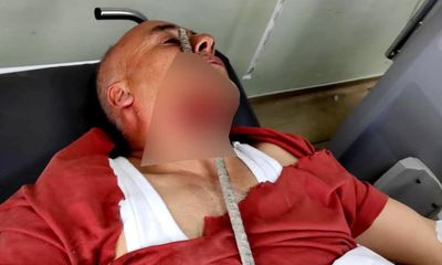 Yüzüne demir saplanan işçi ölümden döndü - Birlik Haber Ajansı