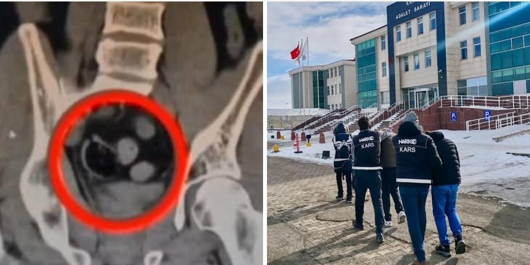 Kars'ta İranlı 3 kişinin bağırsağında uyuşturucu ele geçirildi - Birlik Haber Ajansı