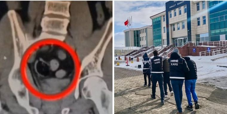 Kars'ta İranlı 3 kişinin bağırsağında uyuşturucu ele geçirildi - Birlik Haber Ajansı