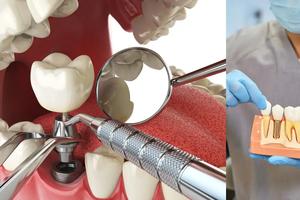 Transform Your Smile with Dental Implants in Southlake, TX: The Ultimate Guide