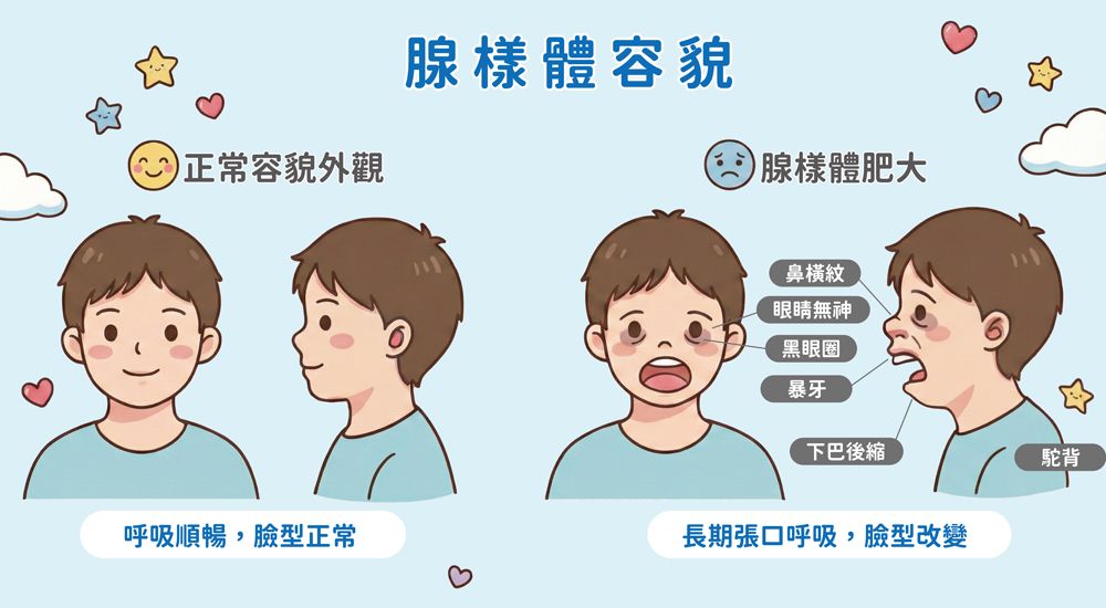 長期用嘴呼吸導致「腺樣體面容」