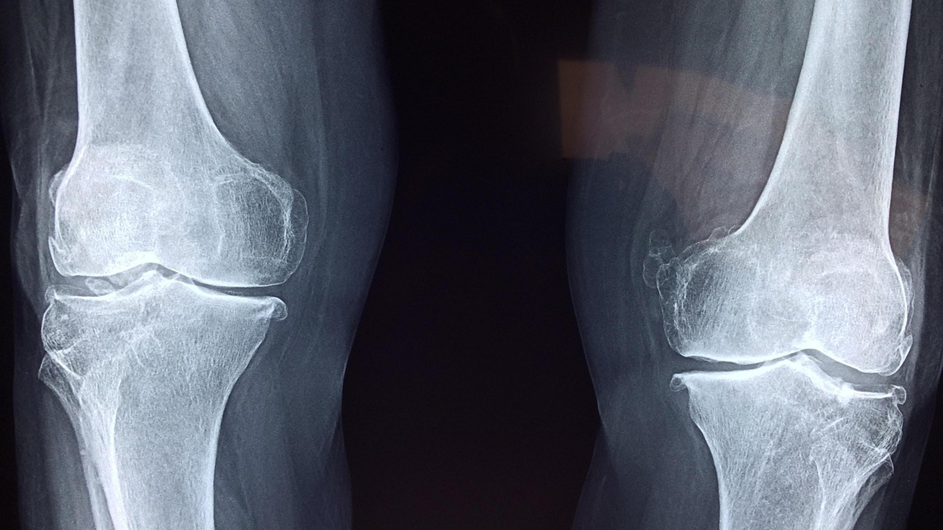 An X-ray image showing the bones of two knee joints