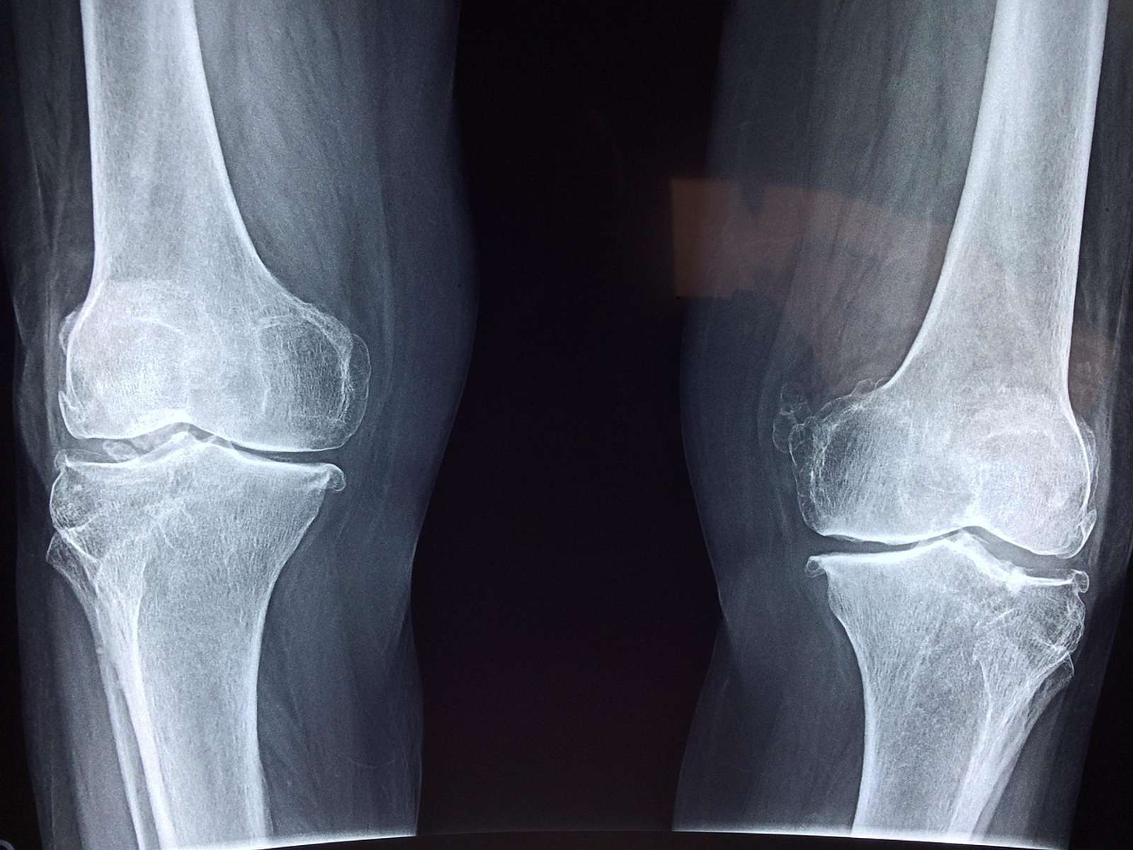 An X-ray image showing the bones of two knee joints