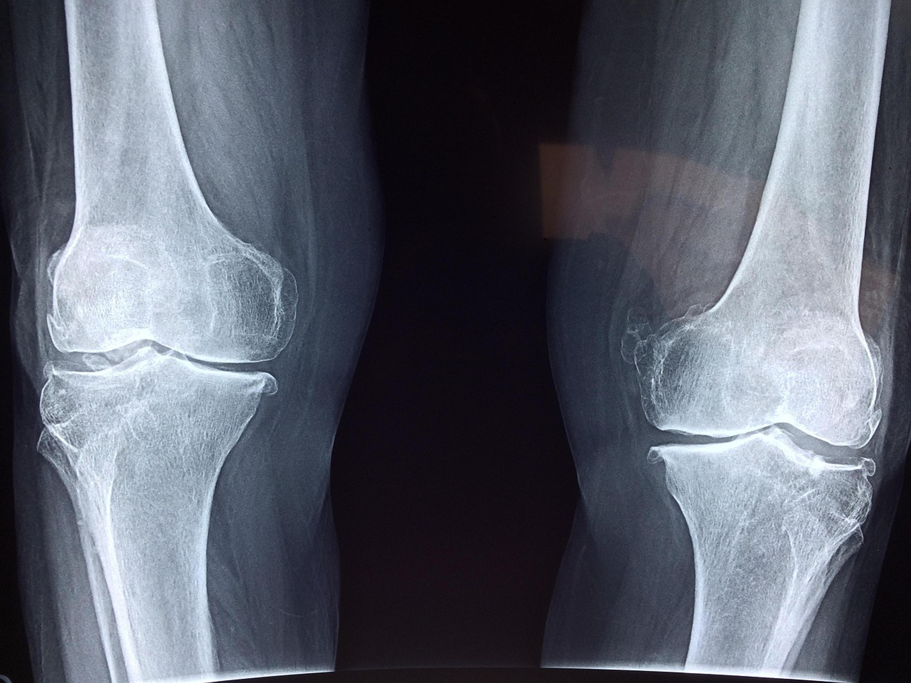 An X-ray image showing the bones of two knee joints