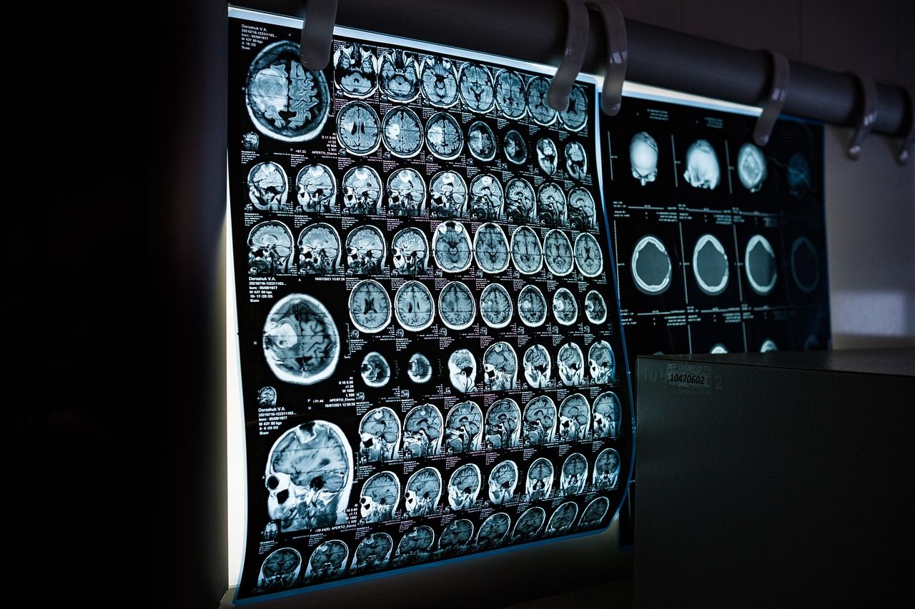 Doctor reviewing a brain MRI scan on a lightbox
