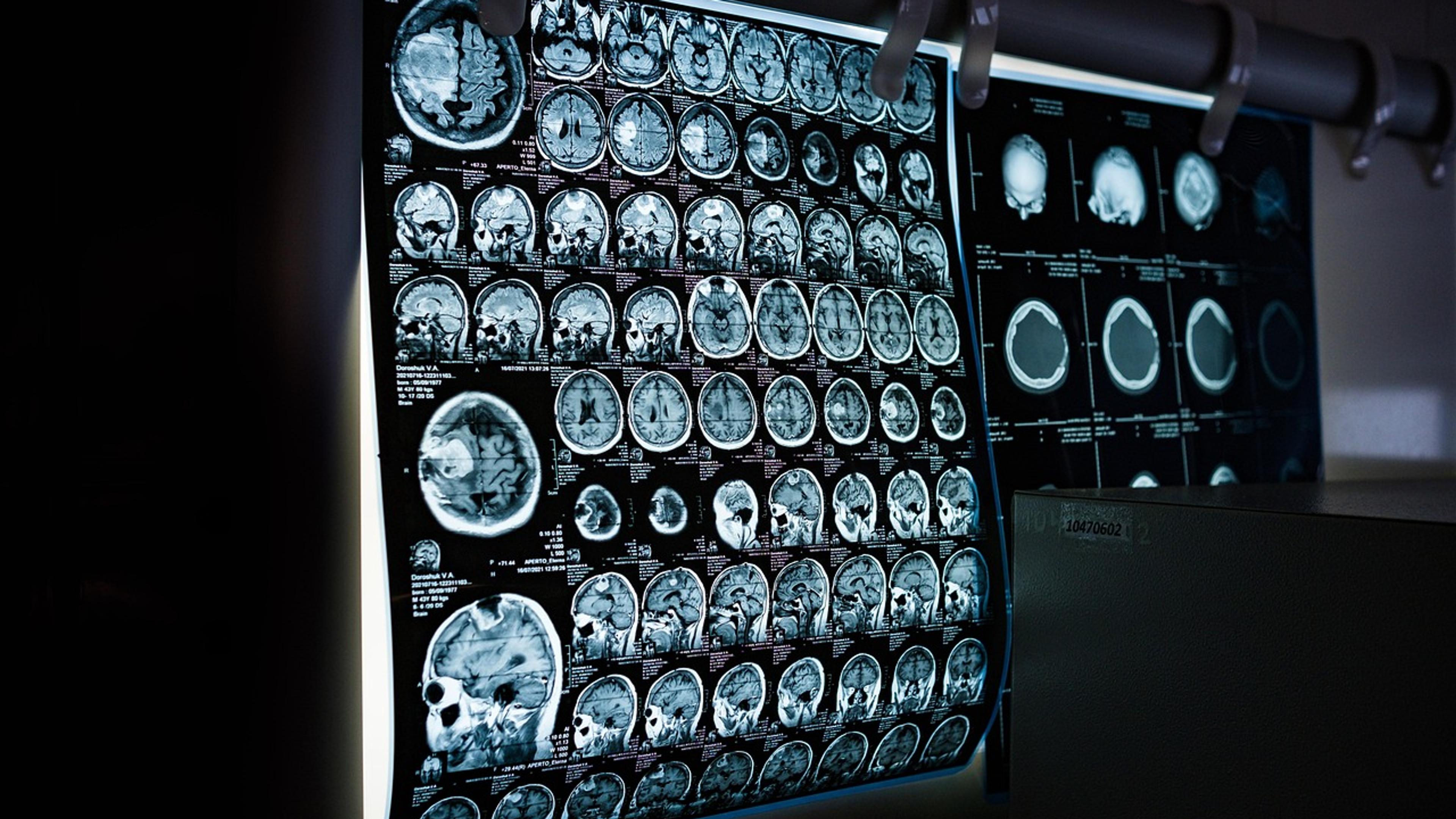 Doctor reviewing a brain MRI scan on a lightbox