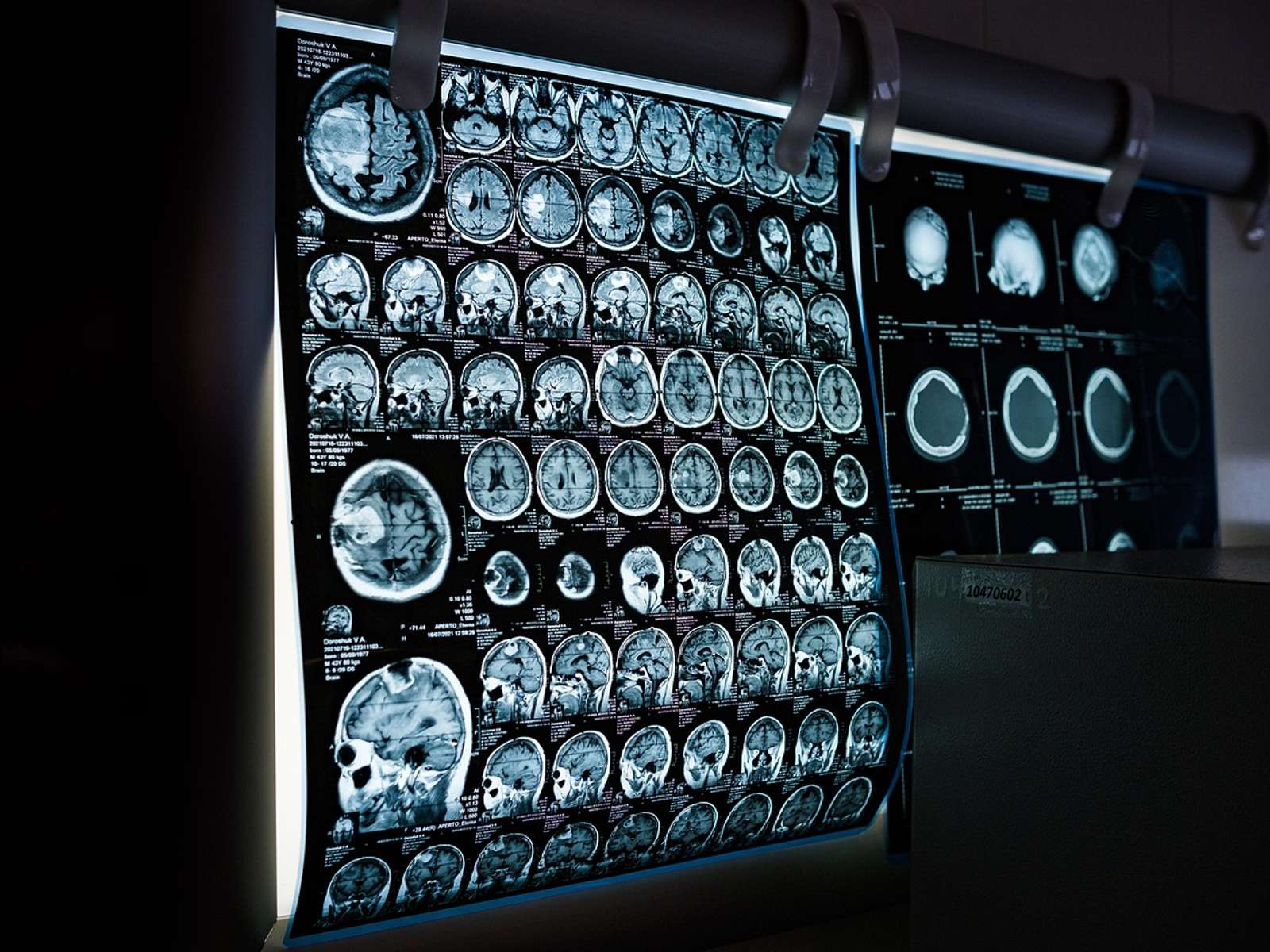 Doctor reviewing a brain MRI scan on a lightbox
